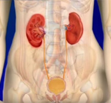 Incontinence urinaire par regorgement