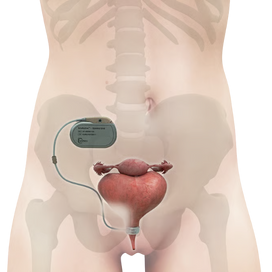 UroMems : quand une start-up française révolutionne le traitement de l’incontinence urinaire